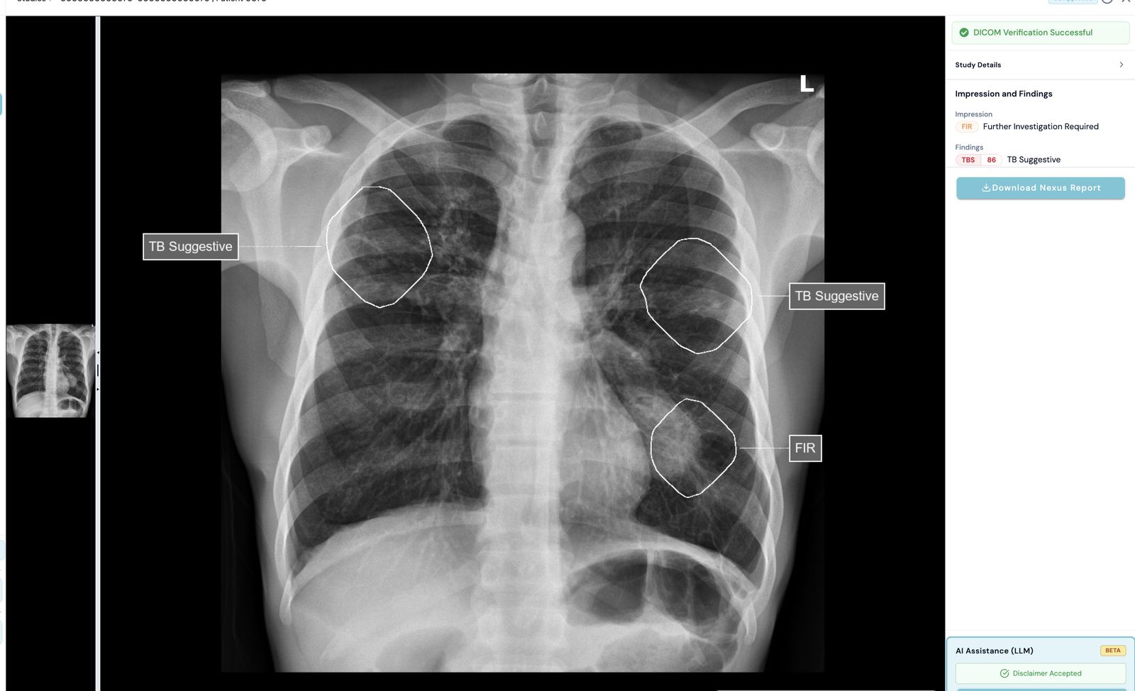 Nexus AI CXR chest X-ray analysis on screen