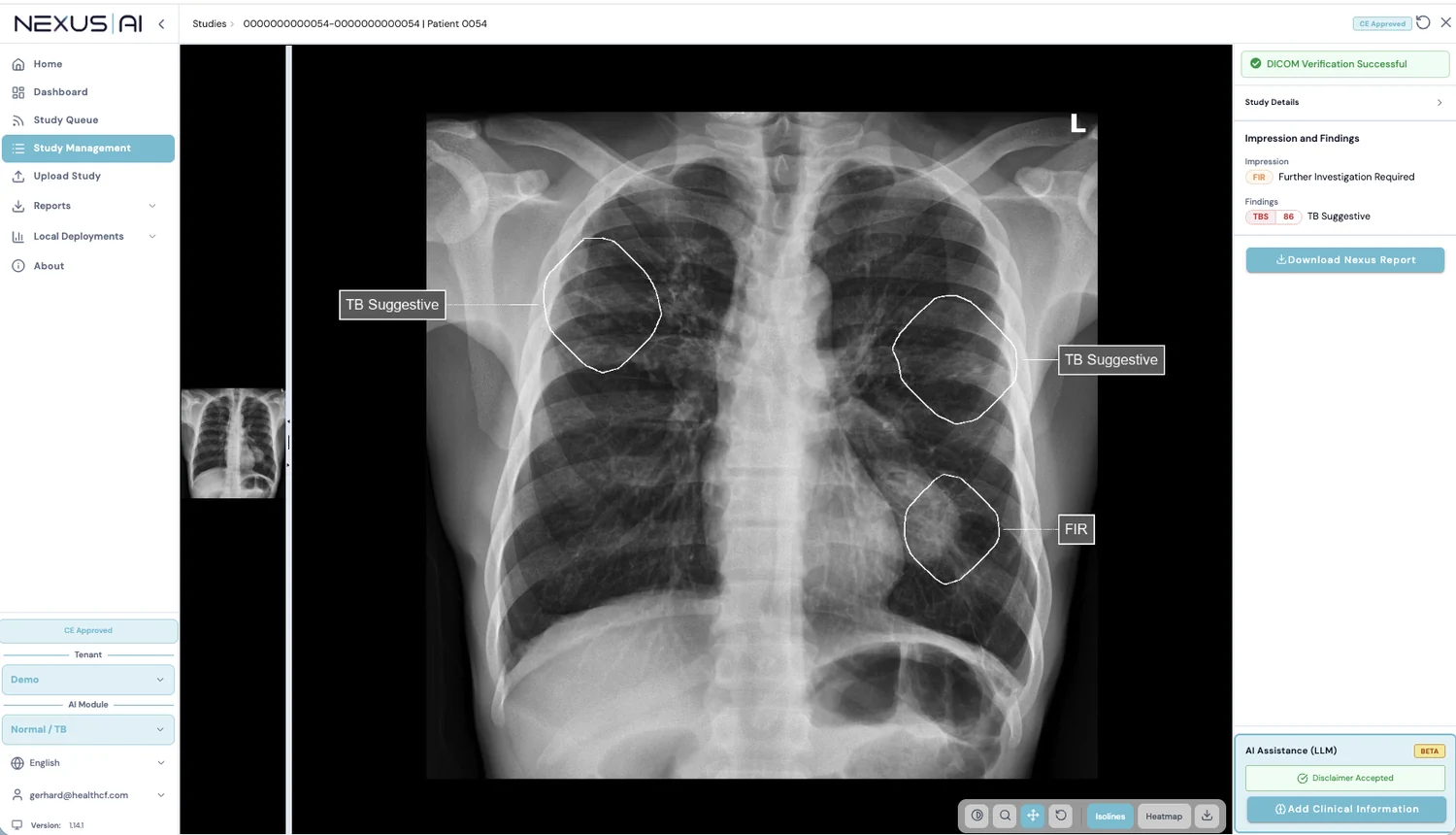 Computer-aided detection of tuberculosis from chest radiographs in a tuberculosis prevalence survey in South Africa: external validation and modelled impacts of commercially available artificial intelligence software